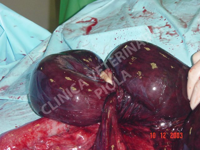 Strangolamento da lipoma peduncolato 4-1
